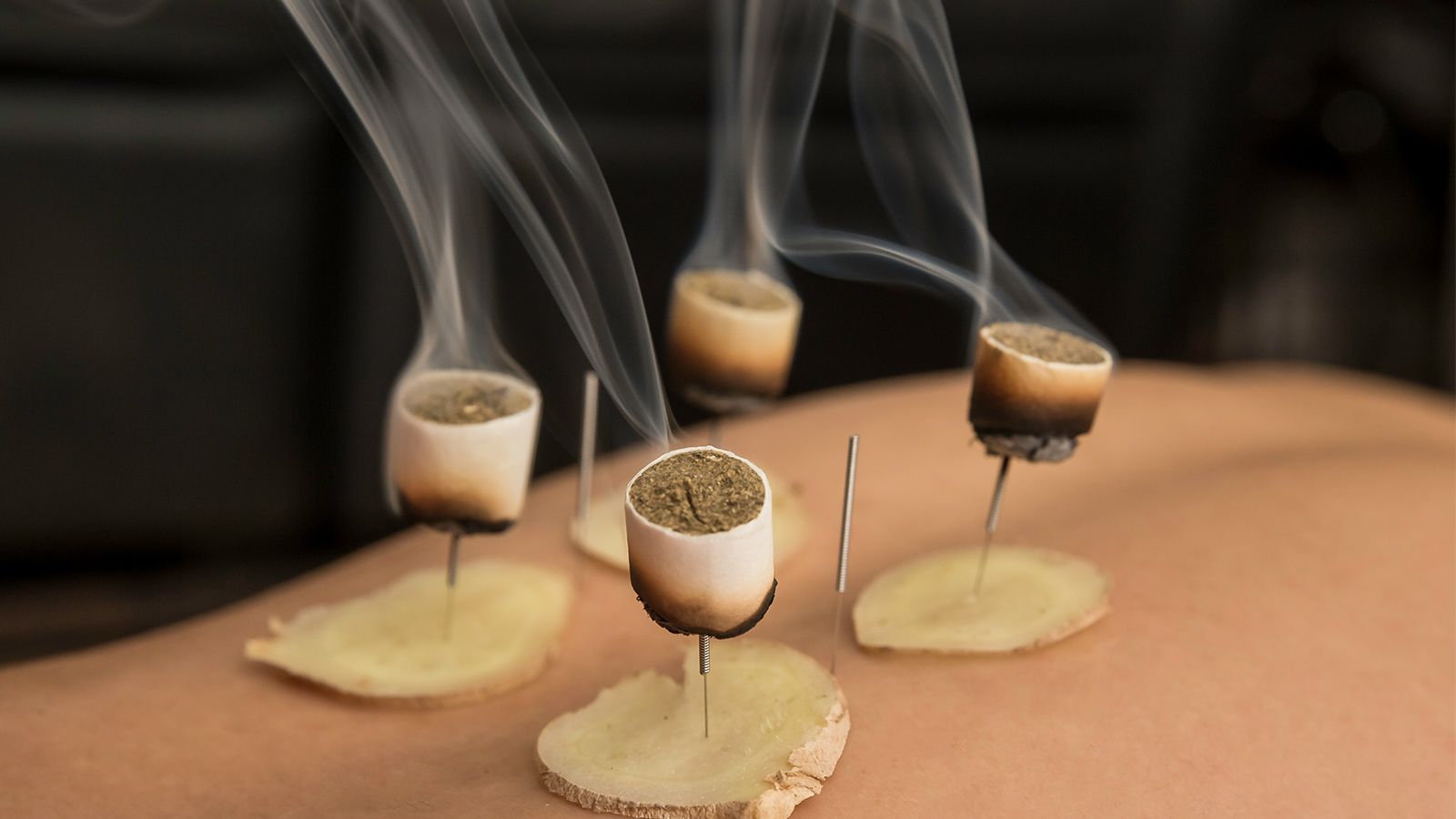 Acupuncture treatment at PulsePoint Acupuncture & Wellness Clinic